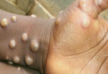 Maymun çiçeği virüsü yayılıyor! Bir ülke 3 ‘mpox’ vakası açıkladı (Maymun çiçeği virüsü belirtileri)
